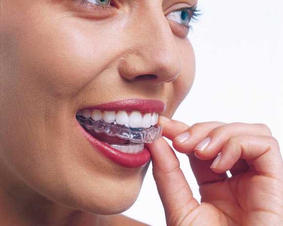 Invisalign treatment in Wirral