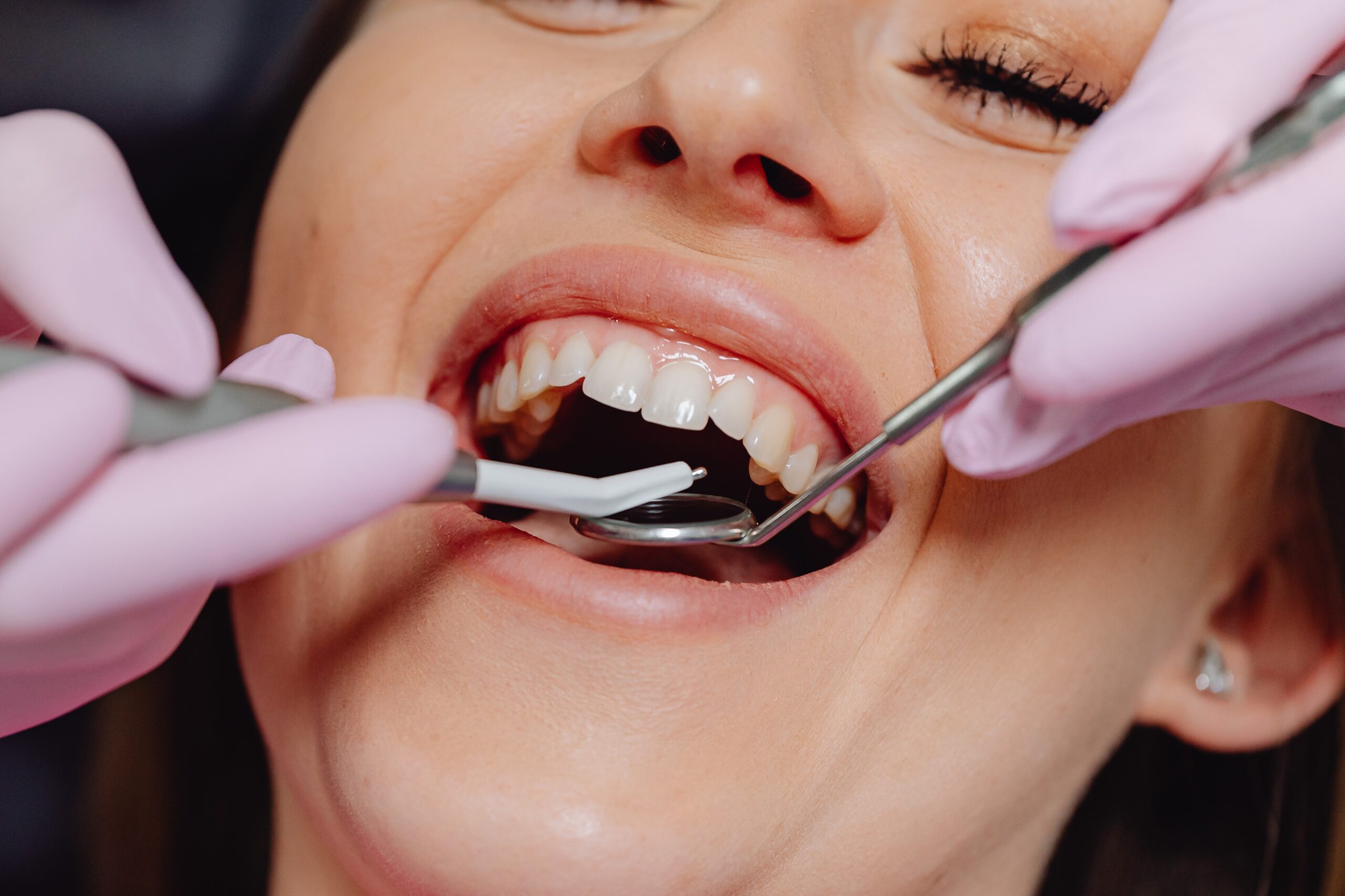 Gum recession