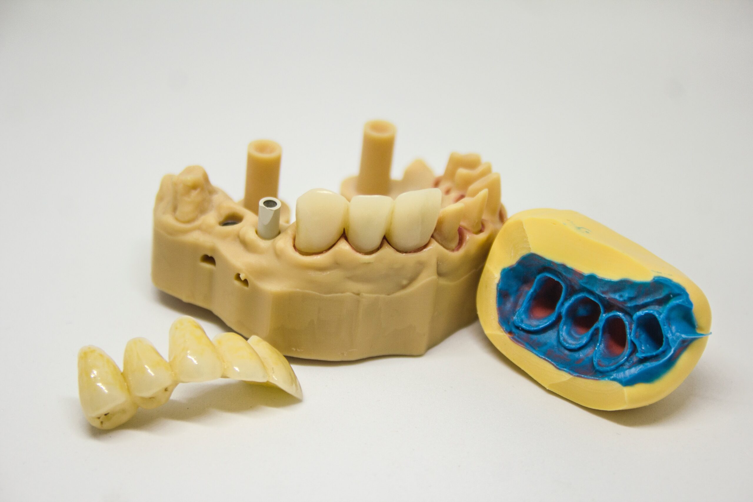 Tooth crown in Wirral