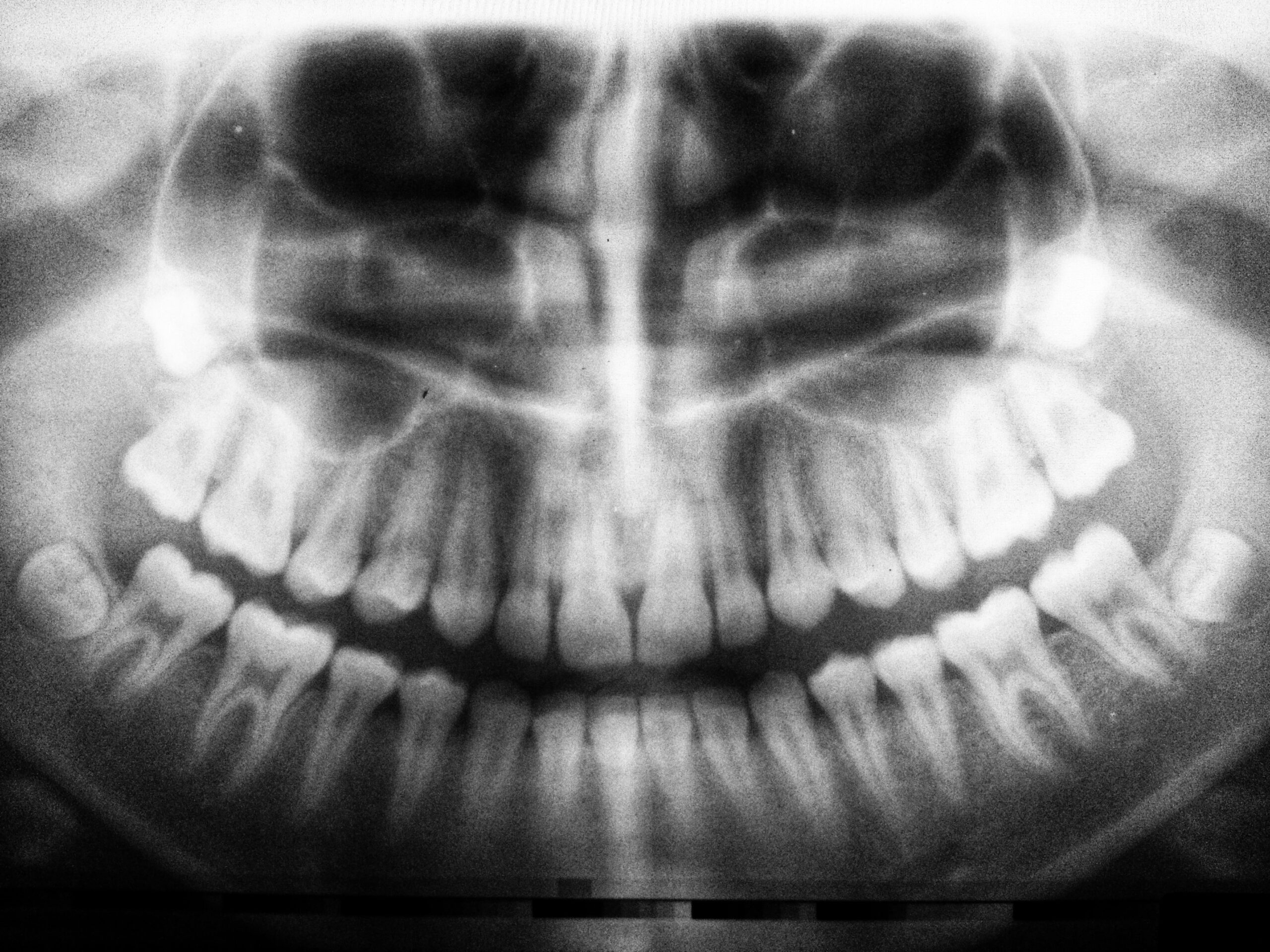 Dental X-rays