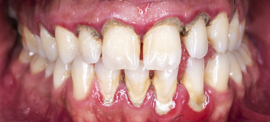 Gum disease