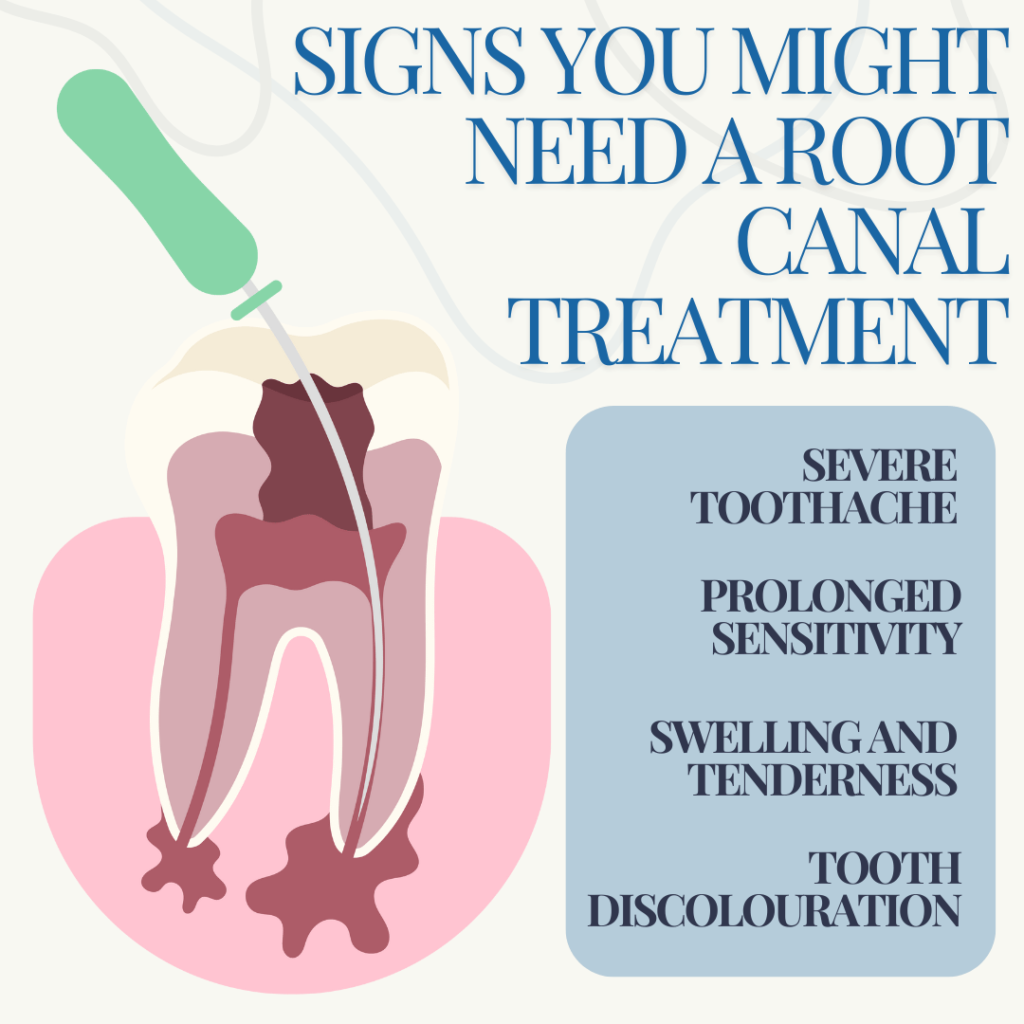 Signs you need root canal treatment