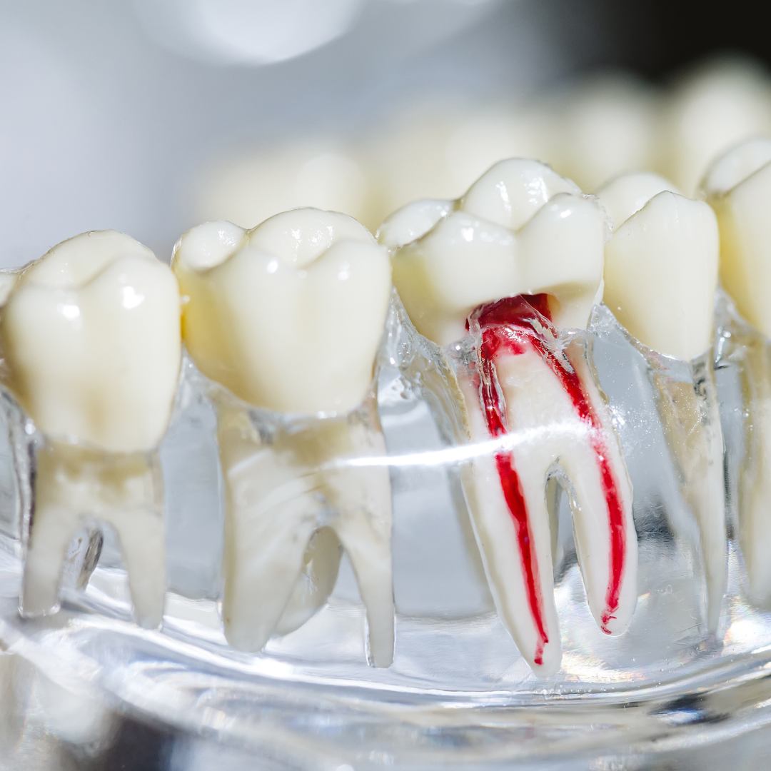 Everything You Need to Know Before a Root Canal