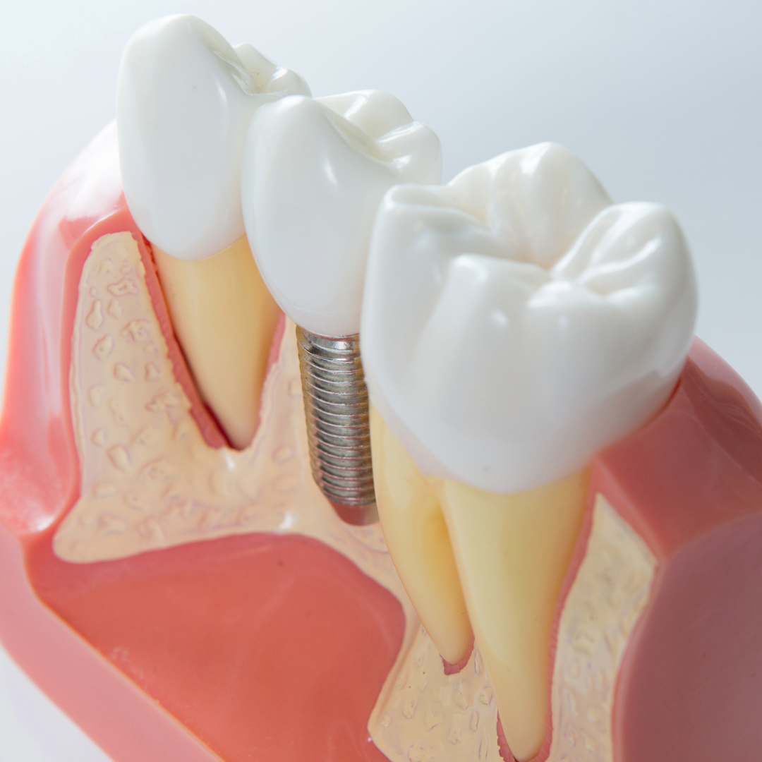 Dental Implants: What to Expect from Consultation to Completion
