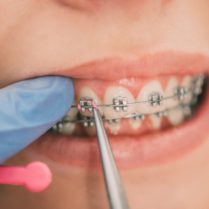 Braces