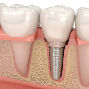Osseointegration