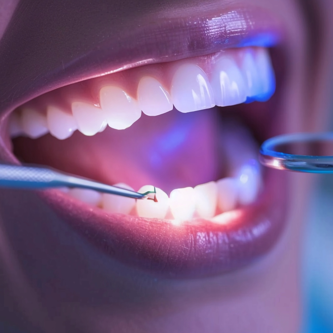 Enhancing Your Smile with Bioclear: A Minimally Invasive Approach