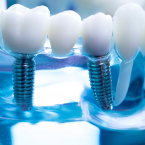 Dental Implants