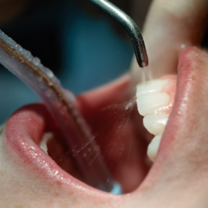 air polishing